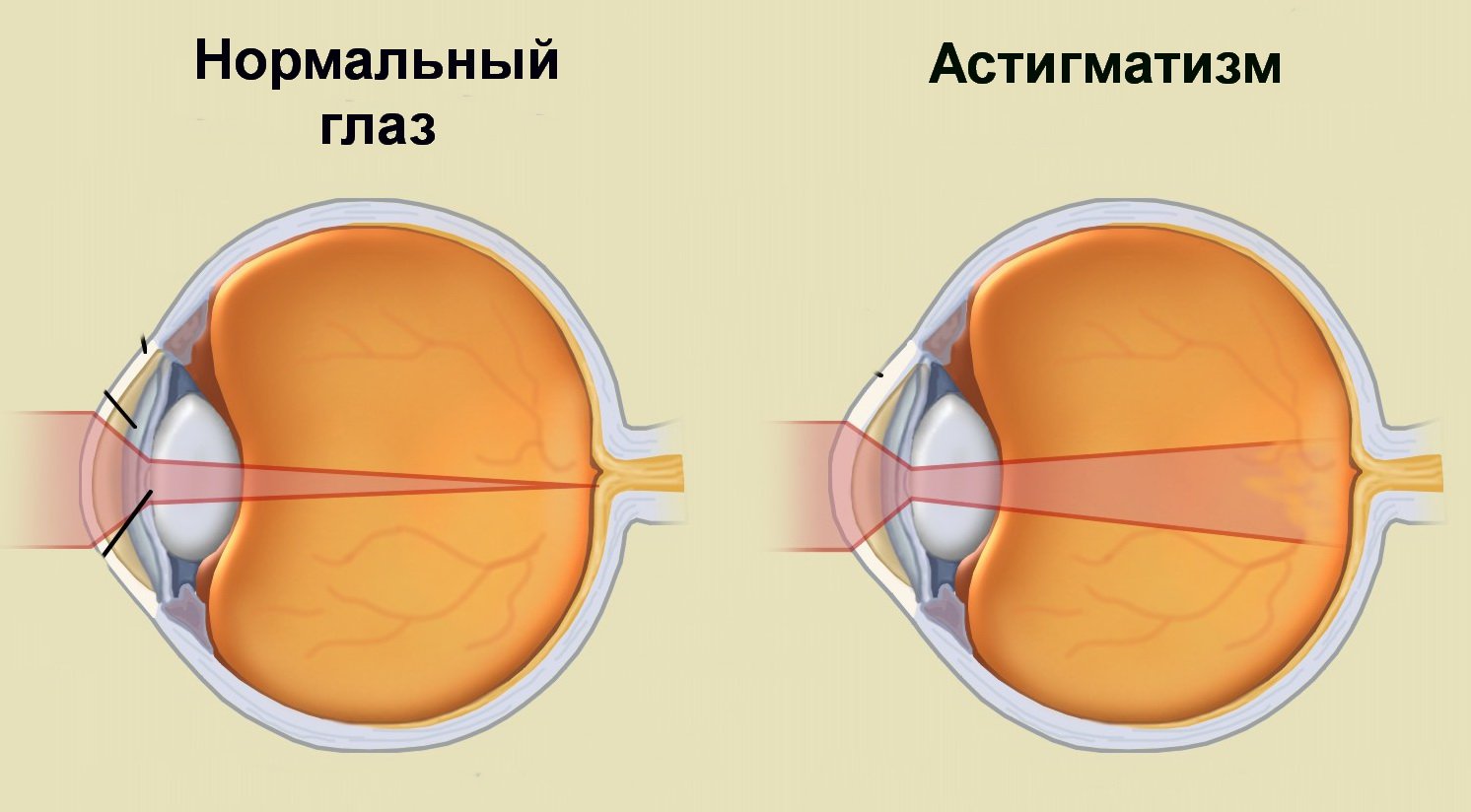 rossz látás tágult pupillák
